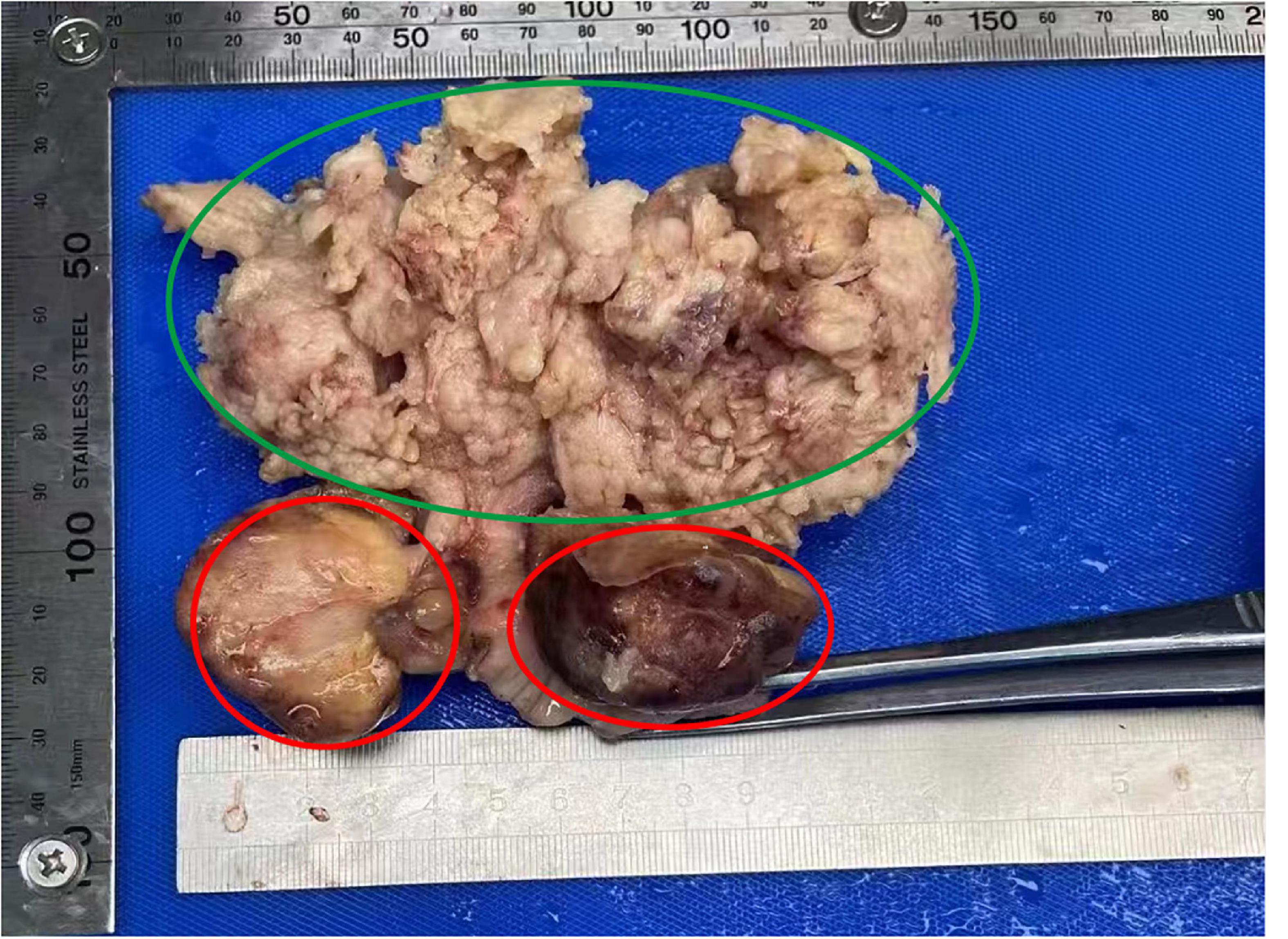 Case report: Highly differentiated endometrial adenocarcinoma that collided with uterine cervical carcinosarcoma